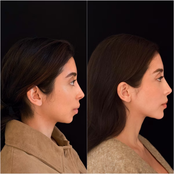 Butterfly Genioplasty Dr Todd Hanna 9