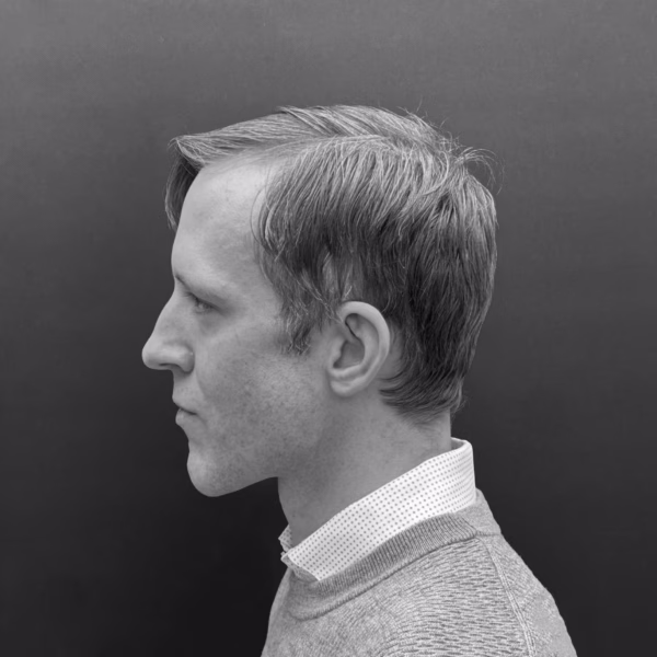 Modified Sagittal Split Osteotomy Todd Hanna - Hanna Face and Jaw Modified Sagittal Split Osteotomy Todd Hanna